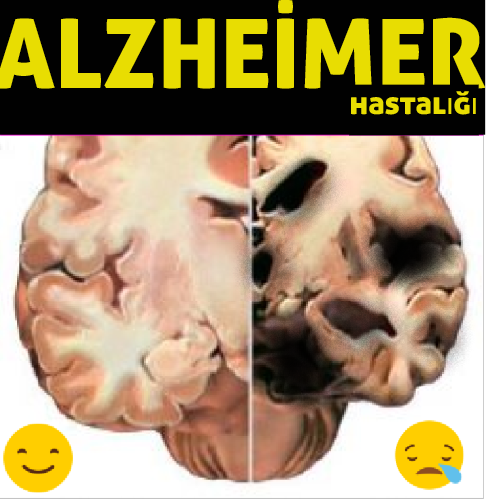 Alzheimer Hastalığı