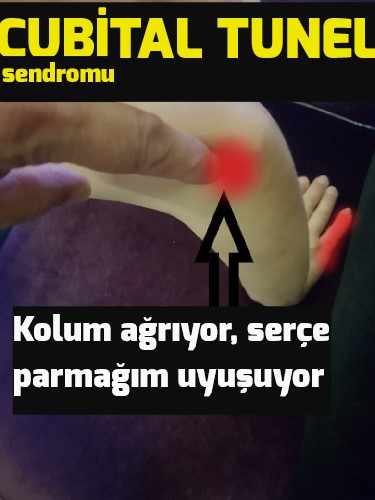 Cubital Tunel Sendromu